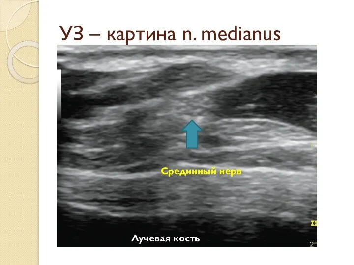 УЗ – картина n. medianus Срединный нерв Лучевая кость