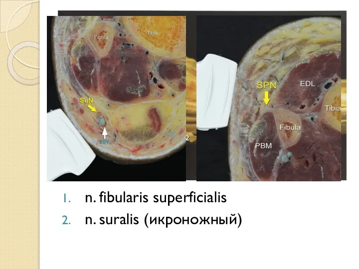 n. fibularis superficialis n. suralis (икроножный)