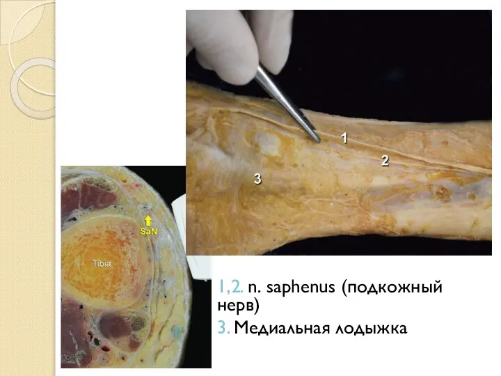 1,2. n. saphenus (подкожный нерв) 3. Медиальная лодыжка