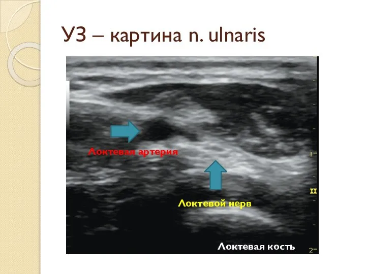УЗ – картина n. ulnaris Локтевой нерв Локтевая артерия Локтевая кость