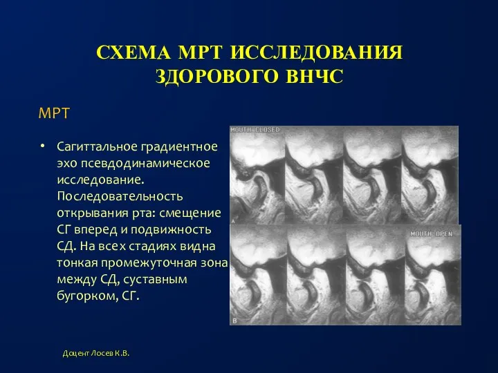 СХЕМА МРТ ИССЛЕДОВАНИЯ ЗДОРОВОГО ВНЧС Сагиттальное градиентное эхо псевдодинамическое исследование. Последовательность открывания