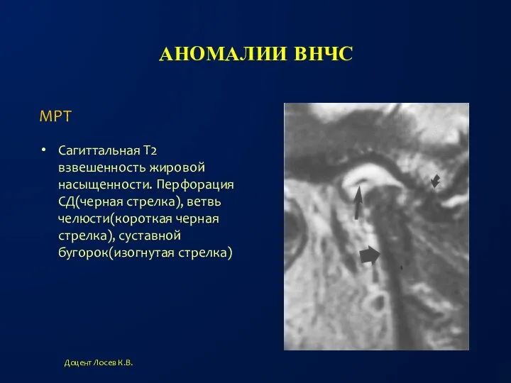 АНОМАЛИИ ВНЧС Сагиттальная Т2 взвешенность жировой насыщенности. Перфорация СД(черная стрелка), ветвь челюсти(короткая