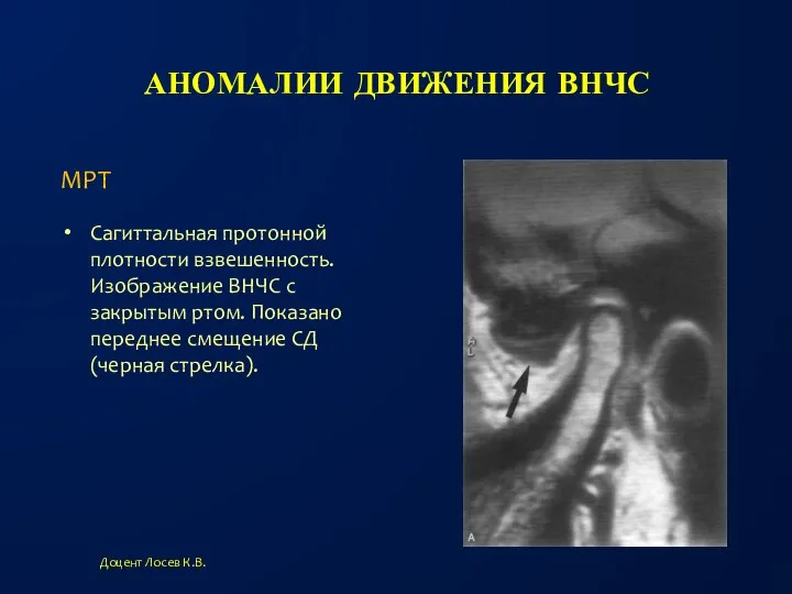 АНОМАЛИИ ДВИЖЕНИЯ ВНЧС Сагиттальная протонной плотности взвешенность. Изображение ВНЧС с закрытым ртом.