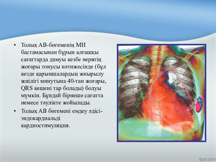 Толық АВ-бөгеменің МИ бастамасынан бұрын алғашқы сағаттарда дамуы кезбе нервтің жоғары тонусы