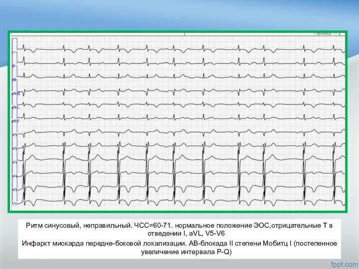 Ритм синусовый, неправильный. ЧСС=60-71. нормальное положение ЭОС,отрицательные Т в отведении I, aVL,