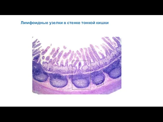 Лимфоидные узелки в стенке тонкой кишки