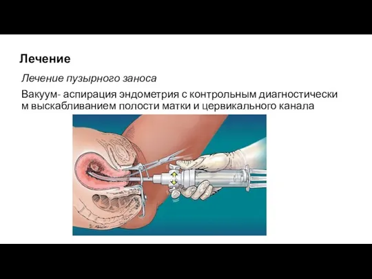 Лечение Лечение пузырного заноса Вакуум- аспирация эндометрия с контрольным диагностическим выскабливанием полости матки и цервикального канала