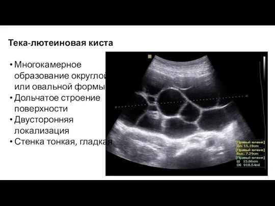 Тека-лютеиновая киста Многокамерное образование округлой или овальной формы Дольчатое строение поверхности Двусторонняя локализация Стенка тонкая, гладкая