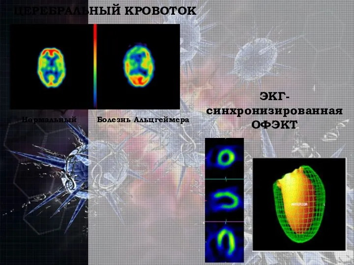 ЦЕРЕБРАЛЬНЫЙ КРОВОТОК Нормальный Болезнь Альцгеймера ЭКГ-синхронизированная ОФЭКТ