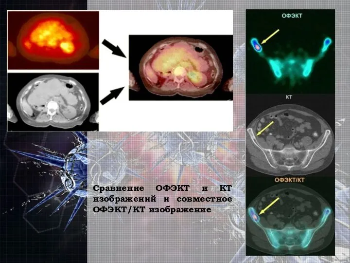 Сравнение ОФЭКТ и КТ изображений и совместное ОФЭКТ/КТ изображение