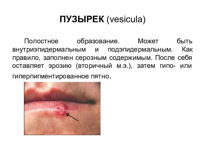 ПУЗЫРЕК (vesicula) Полостное образование. Может быть внутриэпидермальным и подэпидермальным. Как правило, заполнен