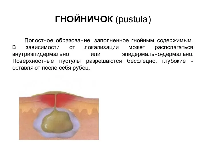 ГНОЙНИЧОК (pustula) Полостное образование, заполненное гнойным содержимым. В зависимости от локализации может