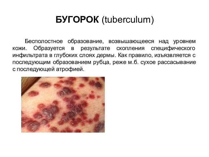 БУГОРОК (tuberculum) Бесполостное образование, возвышающееся над уровнем кожи. Образуется в результате скопления