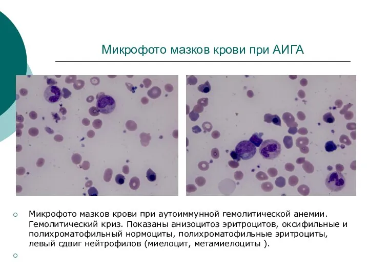 Микрофото мазков крови при АИГА Микрофото мазков крови при аутоиммунной гемолитической анемии.