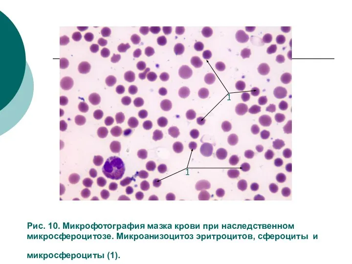 Рис. 10. Микрофотография мазка крови при наследственном микросфероцитозе. Микроанизоцитоз эритроцитов, сфероциты и микросфероциты (1). 1 1