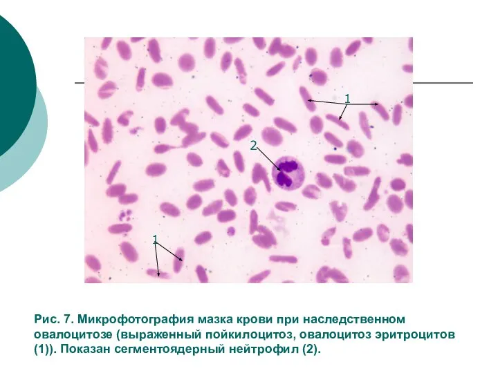 Рис. 7. Микрофотография мазка крови при наследственном овалоцитозе (выраженный пойкилоцитоз, овалоцитоз эритроцитов