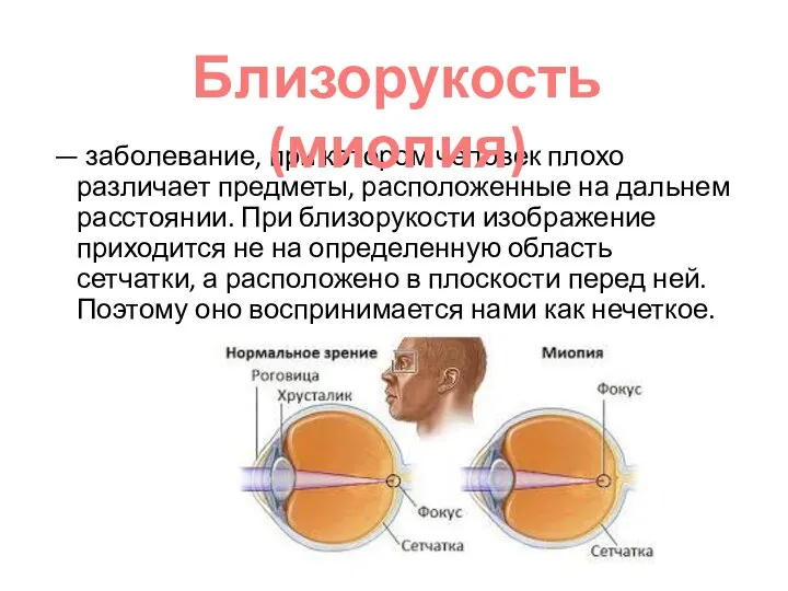 — заболевание, при котором человек плохо различает предметы, расположенные на дальнем расстоянии.