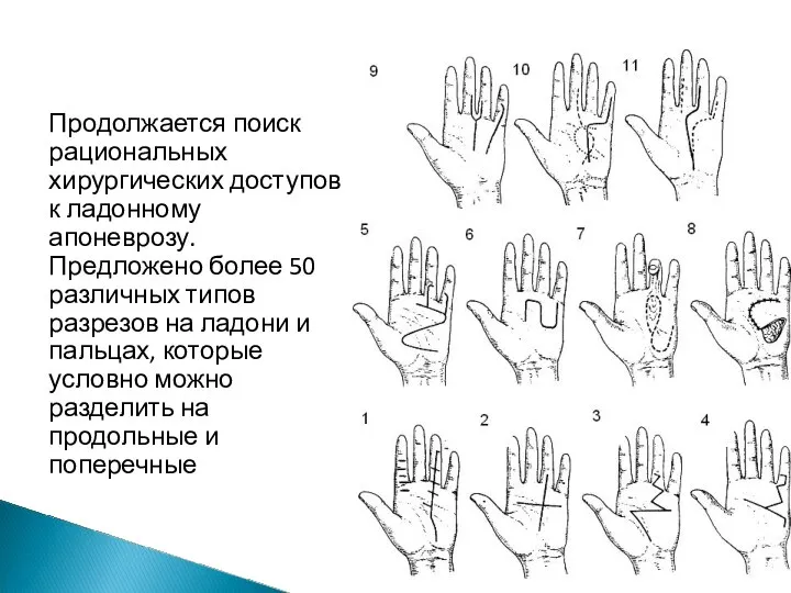 Продолжается поиск рациональных хирургических доступов к ладонному апоневрозу. Предложено более 50 различных