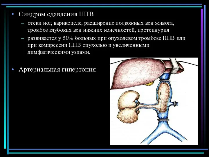 Синдром сдавления НПВ отеки ног, варикоцеле, расширение подкожных вен живота, тромбоз глубоких