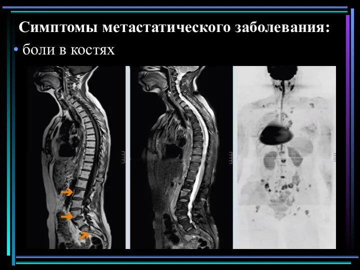 Симптомы метастатического заболевания: боли в костях