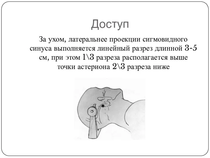 Доступ За ухом, латеральнее проекции сигмовидного синуса выполняется линейный разрез длинной 3-5