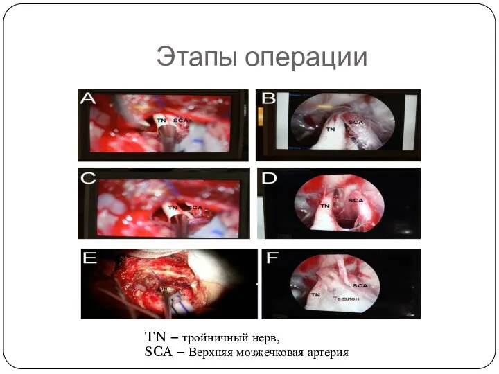 Этапы операции TN – тройничный нерв, SCA – Верхняя мозжечковая артерия