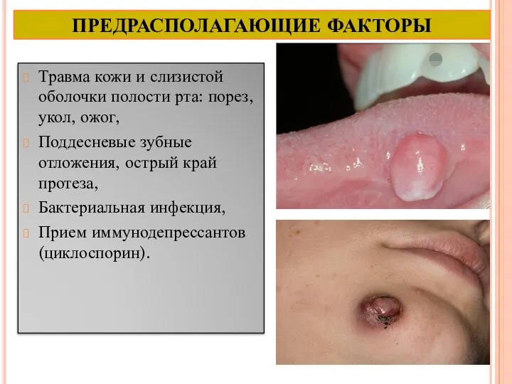 ПРЕДРАСПОЛАГАЮЩИЕ ФАКТОРЫ Травма кожи и слизистой оболочки полости рта: порез, укол, ожог,