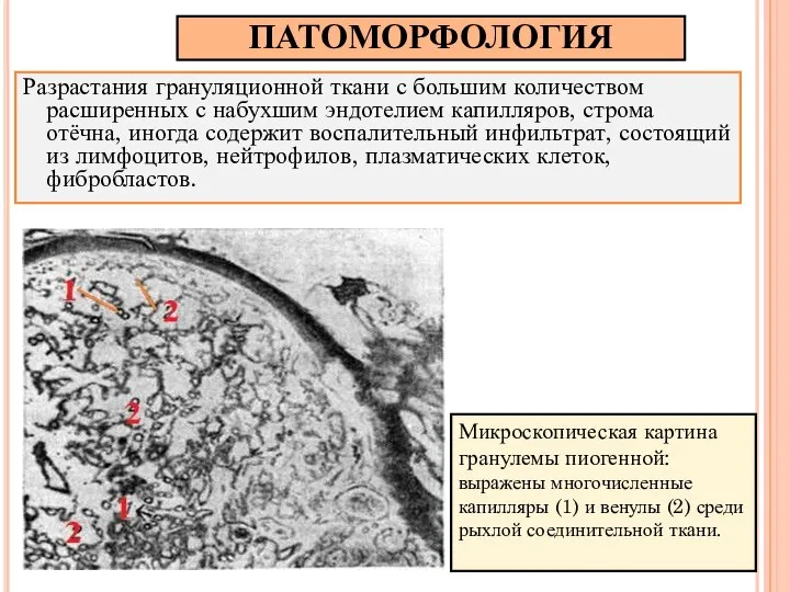 ПАТОМОРФОЛОГИЯ Разрастания грануляционной ткани с большим количеством расширенных с набухшим эндотелием капилляров,