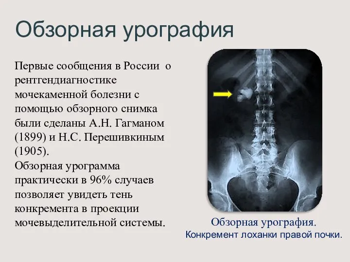 Обзорная урография Первые сообщения в России о рентгендиагностике мочекаменной болезни с помощью