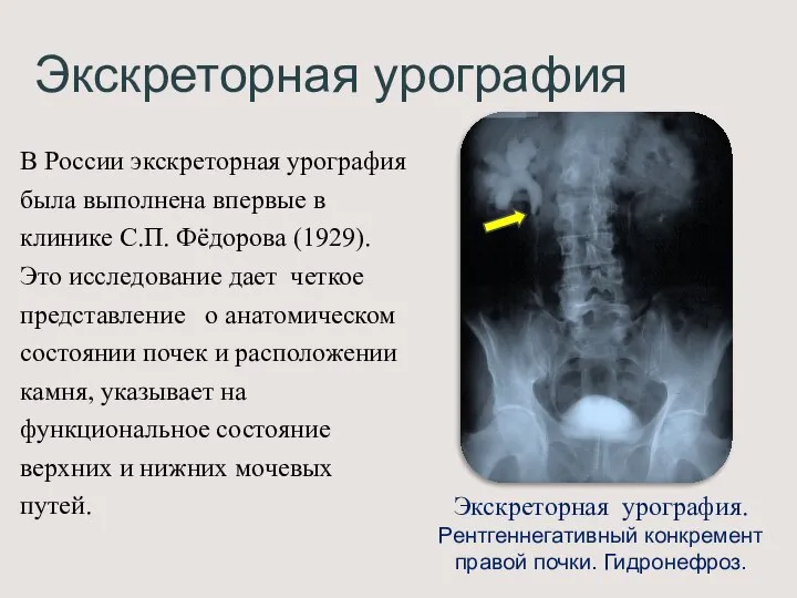 Экскреторная урография В России экскреторная урография была выполнена впервые в клинике С.П.