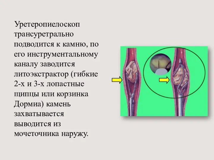 Уретеропиелоскоп трансуретрально подводится к камню, по его инструментальному каналу заводится литоэкстрактор (гибкие