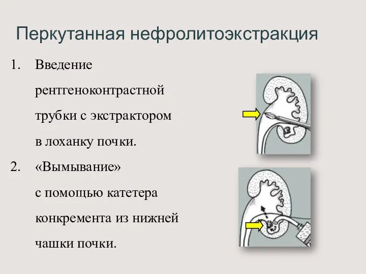 Перкутанная нефролитоэкстракция Введение рентгеноконтрастной трубки с экстрактором в лоханку почки. «Вымывание» с