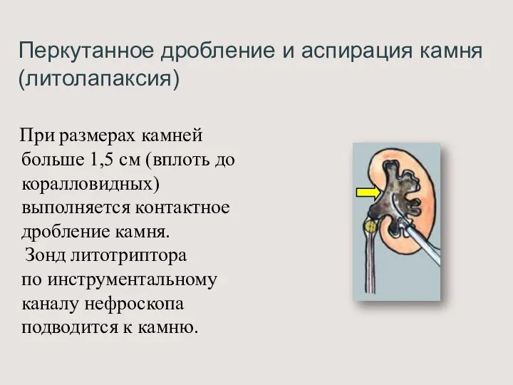 Перкутанное дробление и аспирация камня (литолапаксия) При размерах камней больше 1,5 см