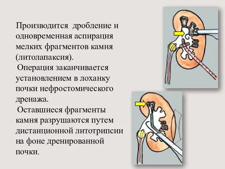 Производится дробление и одновременная аспирация мелких фрагментов камня (литолапаксия). Операция заканчивается установлением