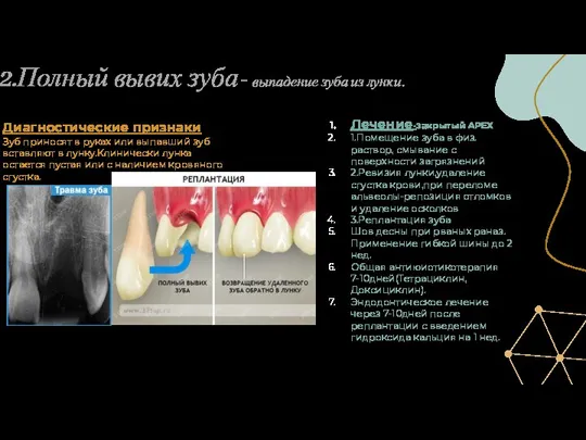 2.Полный вывих зуба- выпадение зуба из лунки. Диагностические признаки Зуб приносят в