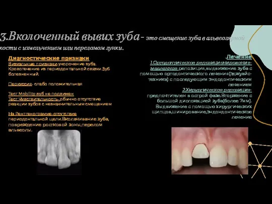 3.Вколоченный вывих зуба- это смещение зуба в альвеолярной кости с измельчением или