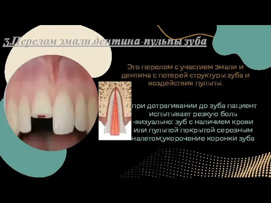Это перелом с участием эмали и дентина с потерей структуры зуба и