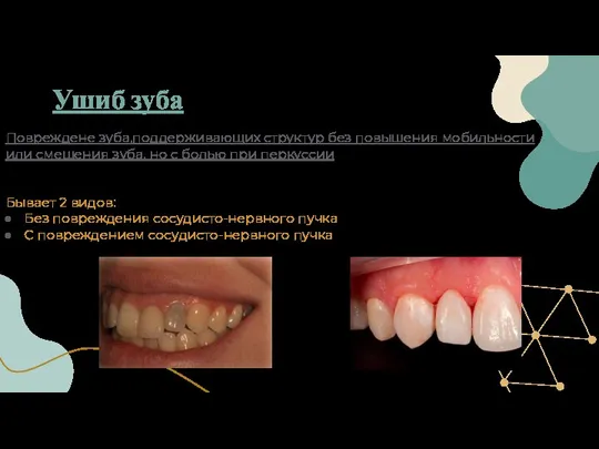 Повреждене зуба,поддерживающих структур без повышения мобильности или смещения зуба, но с болью