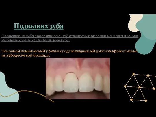 Повреждене зуба,поддерживающей структуры,приводящие к повышению мобильности , но без смещения зуба. Подвывих