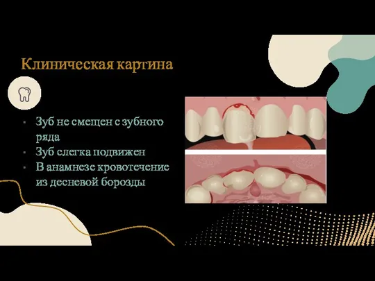 Клиническая картина Зуб не смещен с зубного ряда Зуб слегка подвижен В