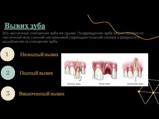 Вывих зуба Вколоченный вывих Неполный вывих Это частичное смещение зуба из лунки.