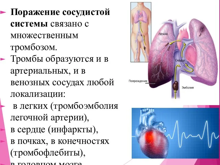 Поражение сосудистой системы связано с множественным тромбозом. Тромбы образуются и в артериальных,