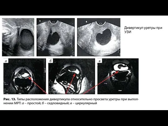 Дивертикул уретры при УЗИ