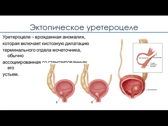 Эктопическое уретероцеле Уретероцеле – врожденная аномалия, которая включает кистозную дилатацию терминального отдела