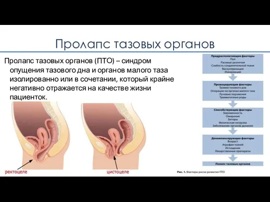 Пролапс тазовых органов Пролапс тазовых органов (ПТО) – синдром опущения тазового дна