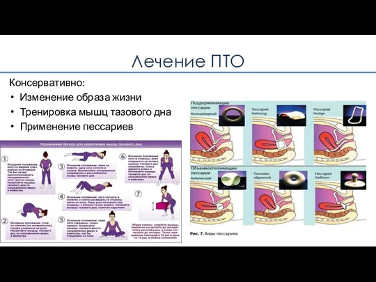 Лечение ПТО Консервативно: Изменение образа жизни Тренировка мышц тазового дна Применение пессариев