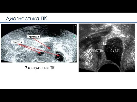 Эхо-признаки ПК Диагностика ПК