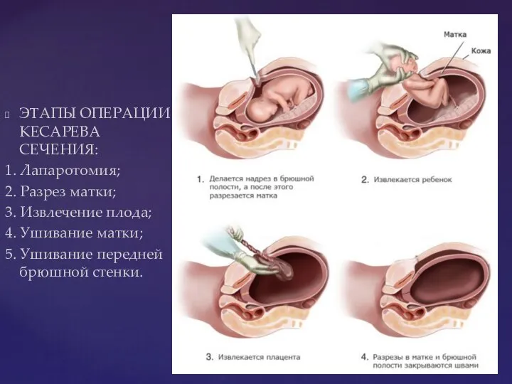 ЭТАПЫ ОПЕРАЦИИ КЕСАРЕВА СЕЧЕНИЯ: 1. Лапаротомия; 2. Разрез матки; 3. Извлечение плода;