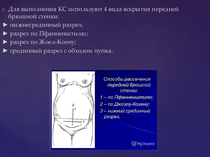 Для выполнения КС используют 4 вида вскрытия передней брюшной стенки: ► нижнесрединный