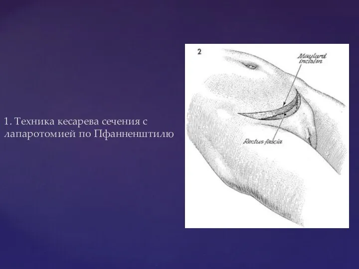 1. Техника кесарева сечения с лапаротомией по Пфанненштилю